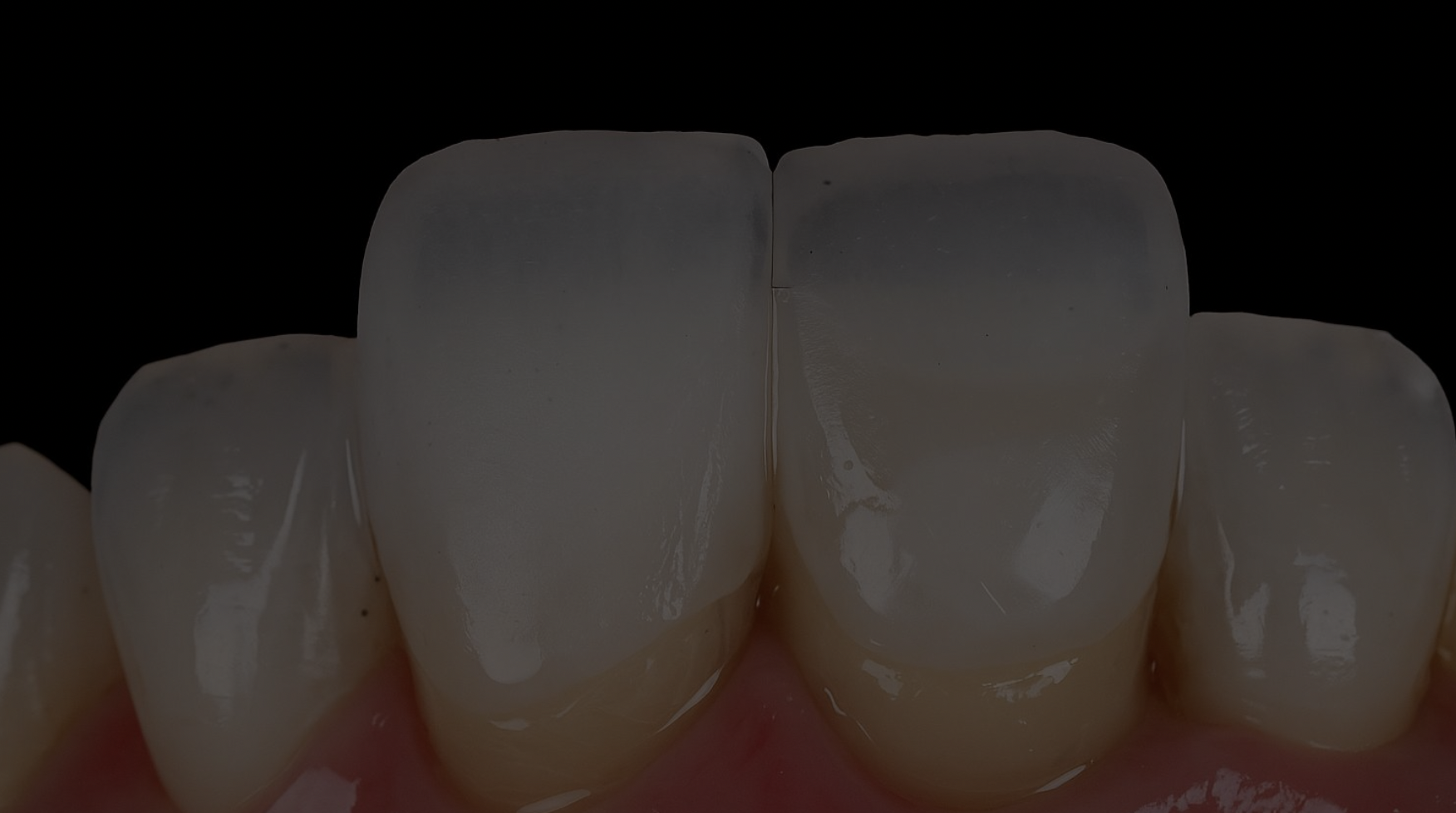 Odontología estética — carillas cerámicas y blanqueamiento en Madrid