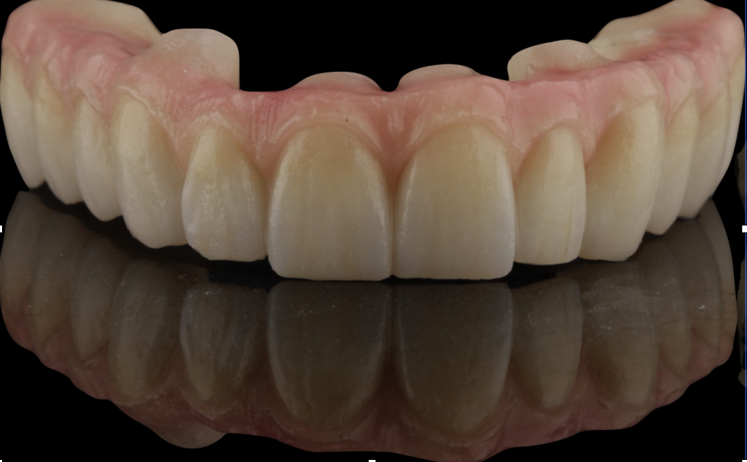 Rehabilitación oral completa sobre implantes