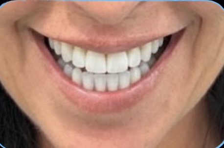 Resultado de diseño de sonrisa personalizado